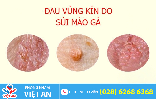 Hình ảnh đau vùng kín ở nữ do mắc sùi mào gà