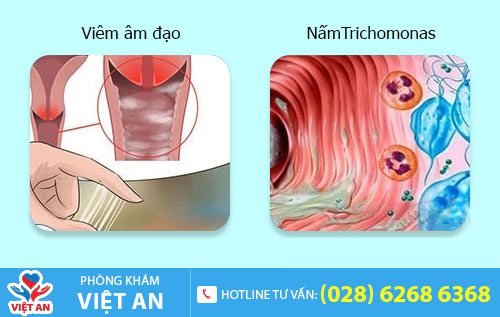 Nguyên nhân khí hư có mùi hôi