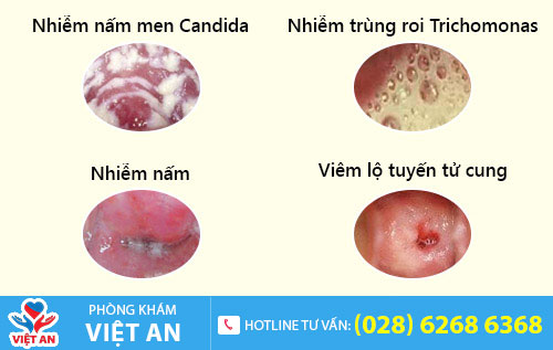 Nguyên nhân ngứa cô bé