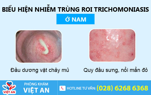 Nhiễm trichomonas ở nam giới
