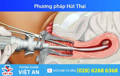 Bỏ thai 8 tuần bằng phương pháp hút thai