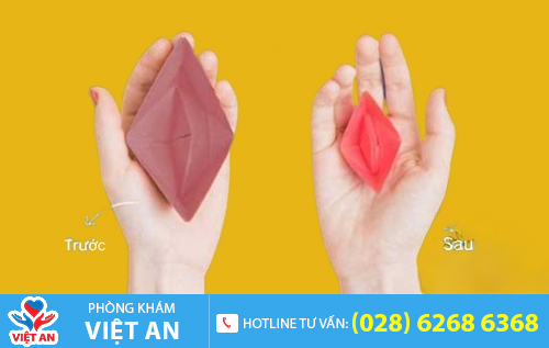 Phương pháp khâu màng trinh