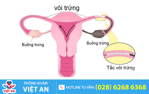 Tắc vòi trứng do viêm nhiễm kéo dài