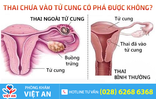 Thai chưa vào tử cung có phá được không