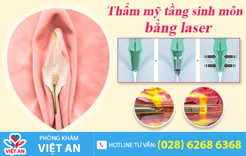 Thẩm mỹ tầng sinh môn bằng phương pháp Laser