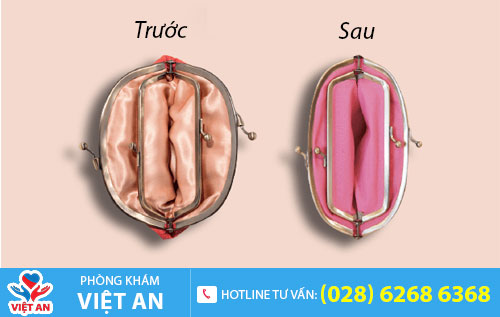 Thu hẹp âm đạo