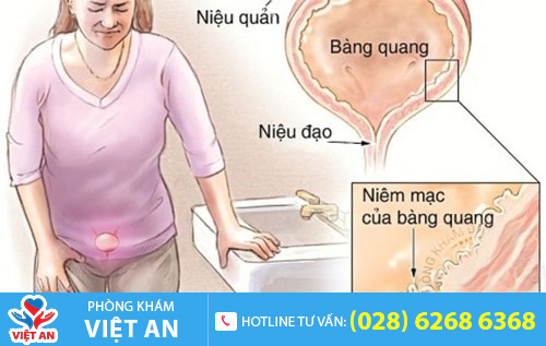 Viêm đường tiết niệu nữ gây ra nhiều biến chứng nguy hiểm