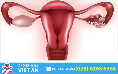 Hình ảnh bệnh viêm phần phụ