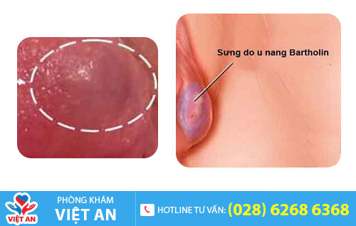 Viêm tuyến Bartholin