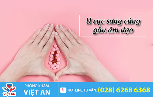 U cục sưng cứng gần âm đạo
