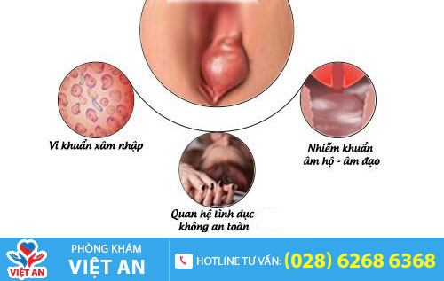 Viêm tuyến bartholin