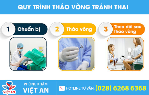 Quy trình tháo vòng tránh thai