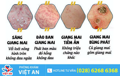 Bệnh giang mai qua các giai đoạn