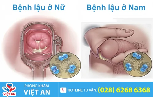 benh lau la gi