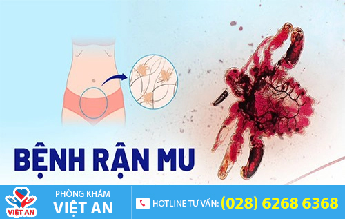 Thuốc hỗ trợ điều trị rận mu hiện nay