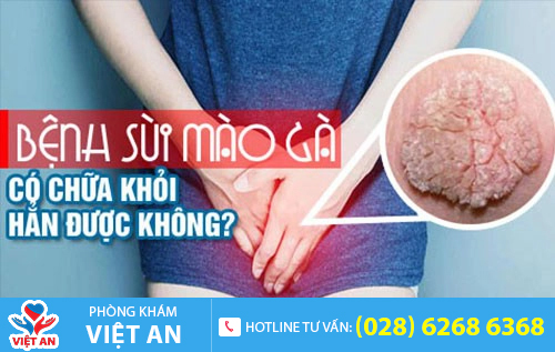Sùi mào gà tái phát hay không?