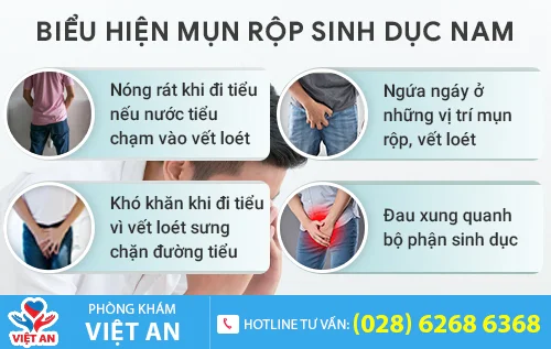 bieu hien benh mun rop sinh duc nam gioi
