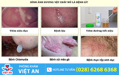 Tiểu ra mủ có thể là dấu hiệu của bệnh lậu
