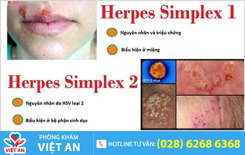 Virus HSV gây mụn rộp sinh dục gồm 2 loại: Type 1 và 2