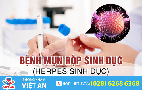 Bệnh mụn rộp sinh dục