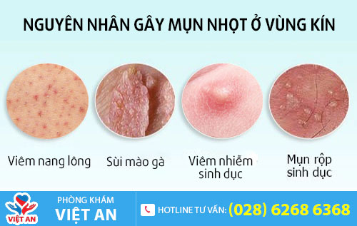 Một số nguyên nhân gây mụn nhọt vùng kín