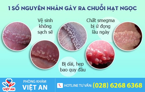 Hình ảnh chuỗi hạt ngọc dương vật