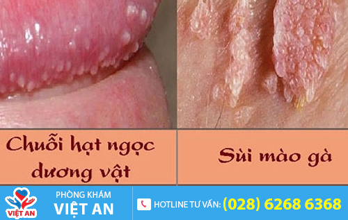 Phân biệt chuỗi hạt ngọc dương vật và sùi mào gà