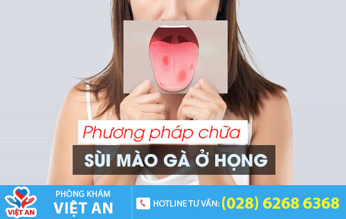 Phương pháp hỗ trợ chữa sùi mào gà ở họng