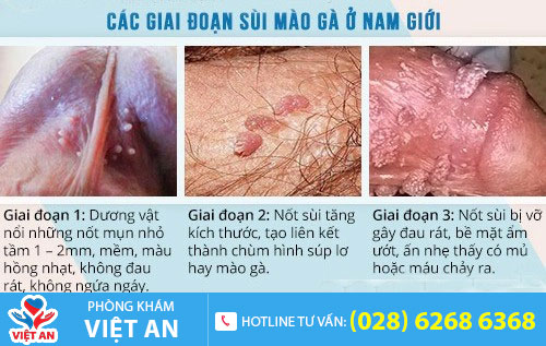 Sùi mào gà ở dương vật