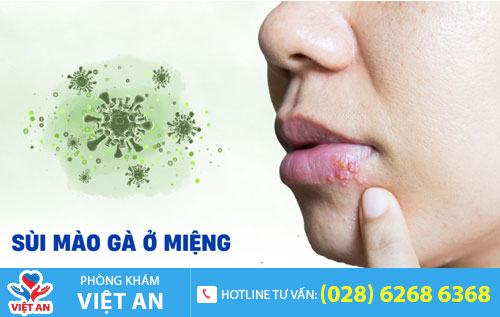 Sùi mào gà ở miệng