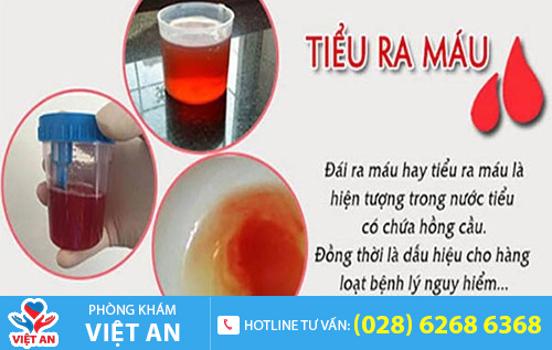 Nguyên nhân gây tiểu buốt ra máu