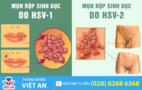 Mụn rộp sinh dục lây nhiễm chủ yếu qua đường quan hệ tình dục không an toàn