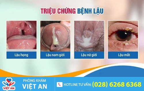 trieu chung benh lau