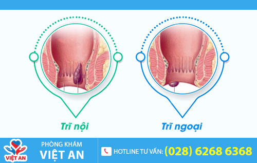 bệnh trĩ