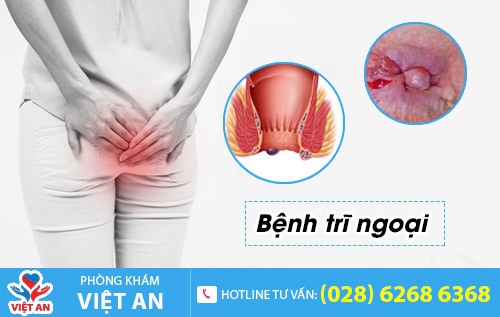 Bệnh trĩ ngoại