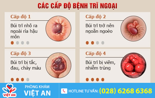 Quá trình phát triển của bệnh trĩ ngoại