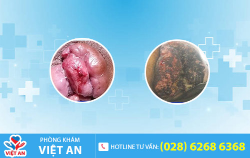 Biến chứng nguy hiểm của bệnh trĩ
