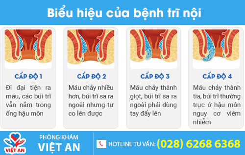 Biểu hiện bệnh trĩ nội