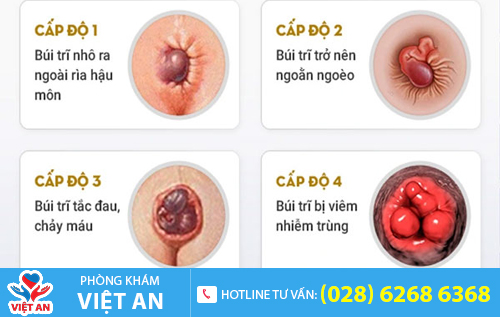 Hình ảnh bệnh trĩ