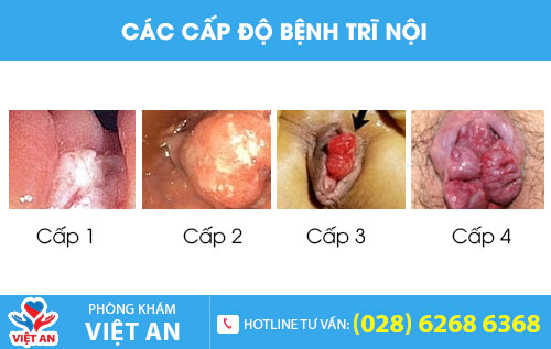 Các cấp độ bệnh trĩ nội