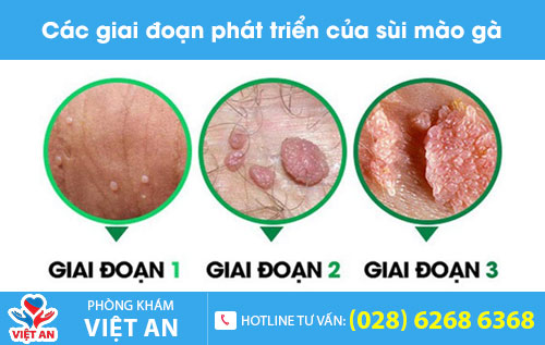 Các giai đoạn phát triển của sùi mào gà