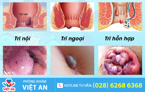 Các loại bệnh trĩ