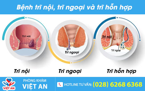 Các loại bệnh trĩ