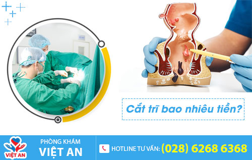 Cắt trĩ bao nhiêu tiền?