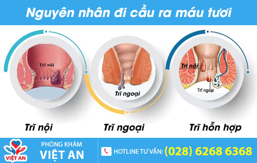 Nguyên nhân đi cầu ra máu tươi