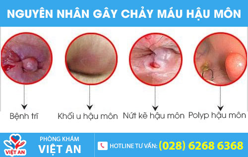 Nguyên nhân gây chảy máu hậu môn