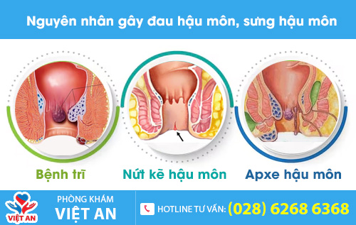 Một số nguyên nhân gây đau hậu môn, sưng hậu môn