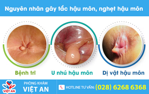 Một số nguyên nhân gây tắc hậu môn, nghẹt hậu môn