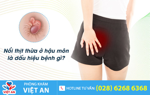 Nổi thịt thừa ở hậu môn