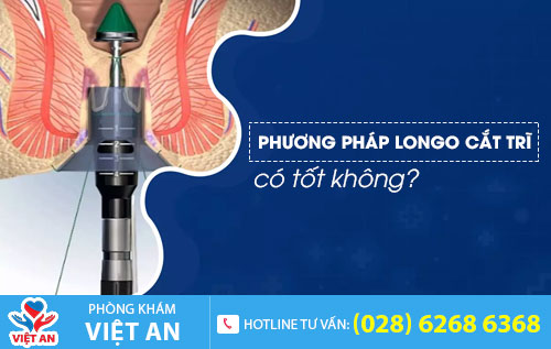 Phương pháp longo cắt trĩ có tốt không?